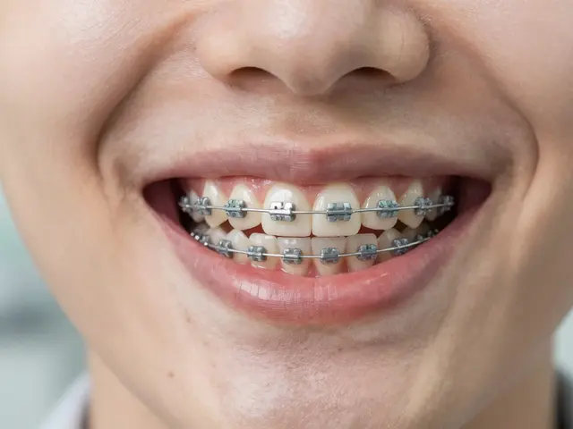 Keramická rovnátka: Jak se vyhnout návštěvě ortodontisty