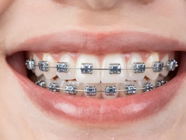 Keramické rovnátka a ústní hygiena: Kompletní průvodce pro čisté zuby