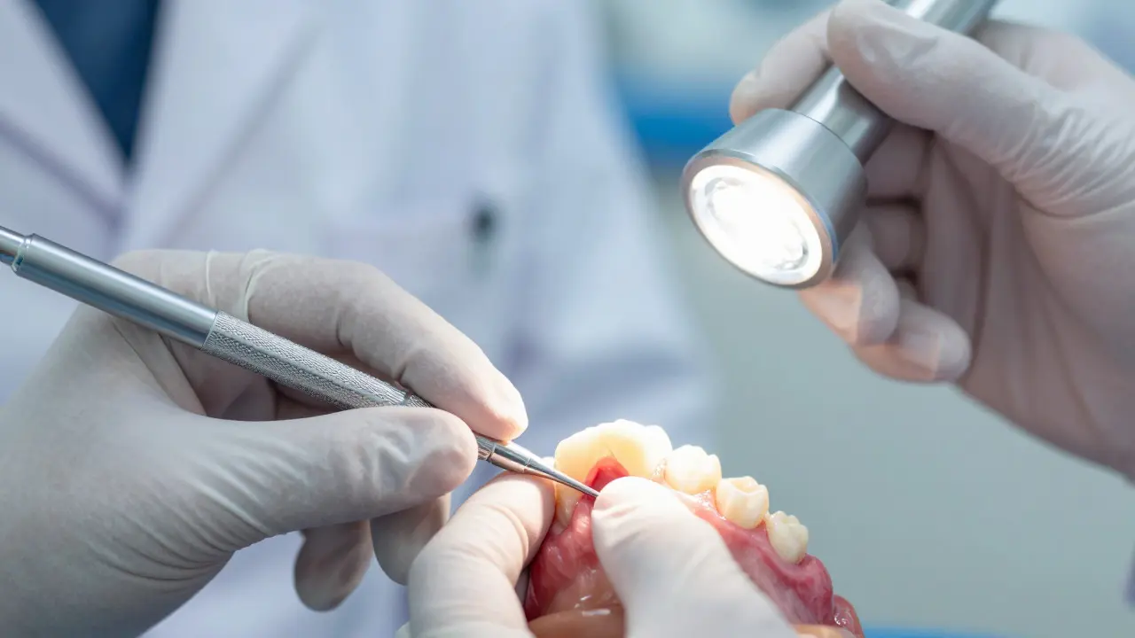 Co je kyretáž zubů? Kompletní průvodce po proceduře, bolestivosti a cenou